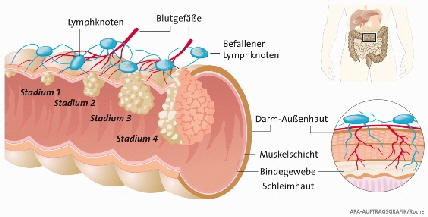 Adenomkarzinomsequenz
