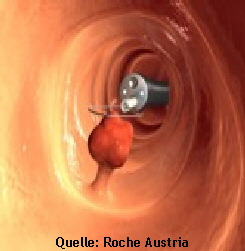 Polypektomie